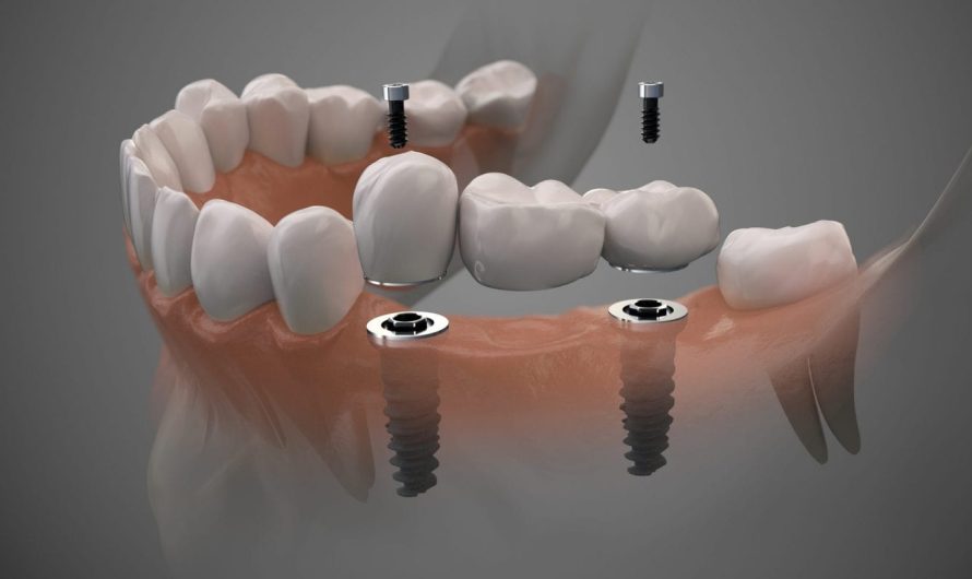 Global Dental Implants Market Is Estimated To Witness High Growth Owing To Increasing Demand for Advanced Dental Solutions