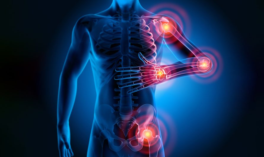 The Fibromyalgia Treatment Market: Advancements and Opportunities