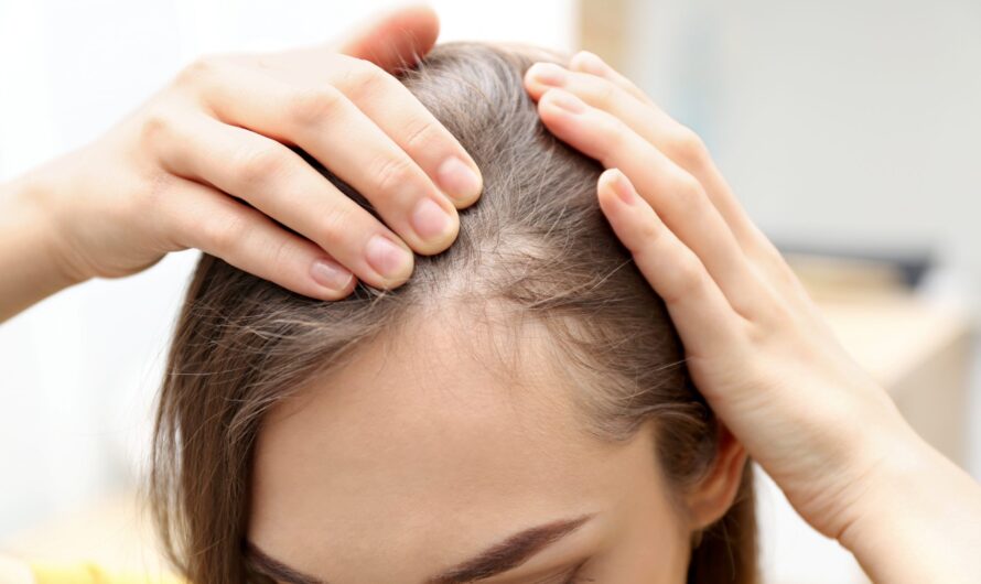 The Alopecia Treatment Market Is Estimated To Witness High Growth Owing To Increasing Awareness About Alopecia Among Population