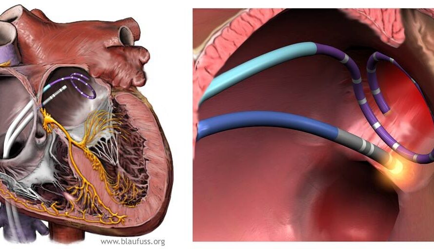 Pulsed Field Ablation Proven to be Safe and Effective for Women with Atrial Fibrillation
