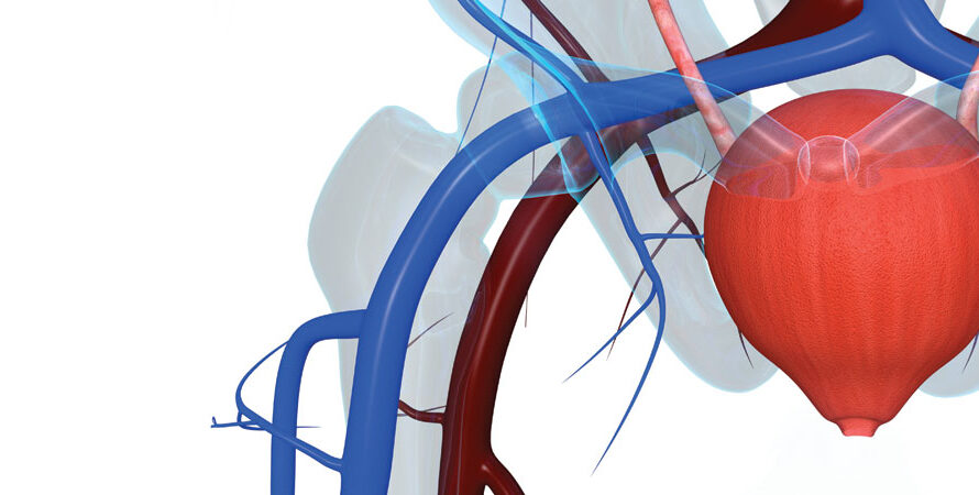Prostatic Artery Embolization Market Is Expected To Be Flourished By Rising Prevalence Of Benign Prostatic Hyperplasia
