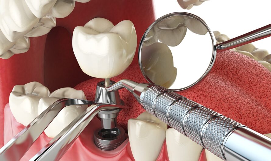 Revolutionizing Smiles: The Advancements in Dental Implants