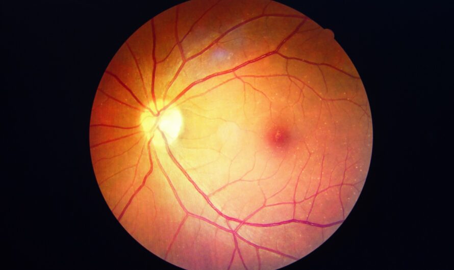Diabetic Retinopathy: A Silent Threat To Vision