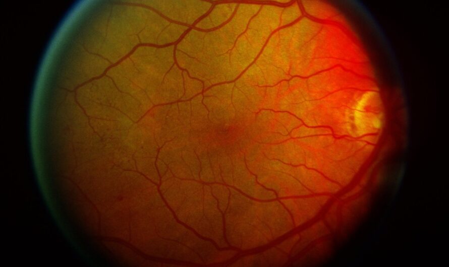Diabetic Retinopathy Market Propelled By Rapid Growth In Prevalence Of Diabetic Retinitis