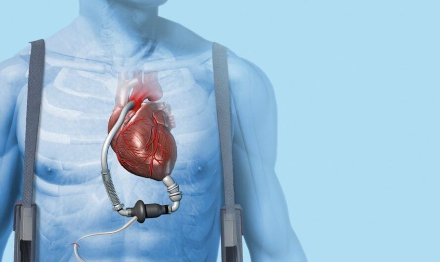 Cardiac Assist Devices Market Primed for Growth Due to Advancements in Miniaturization Technologies