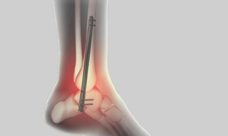 Global Ankle Fusion Nail Market