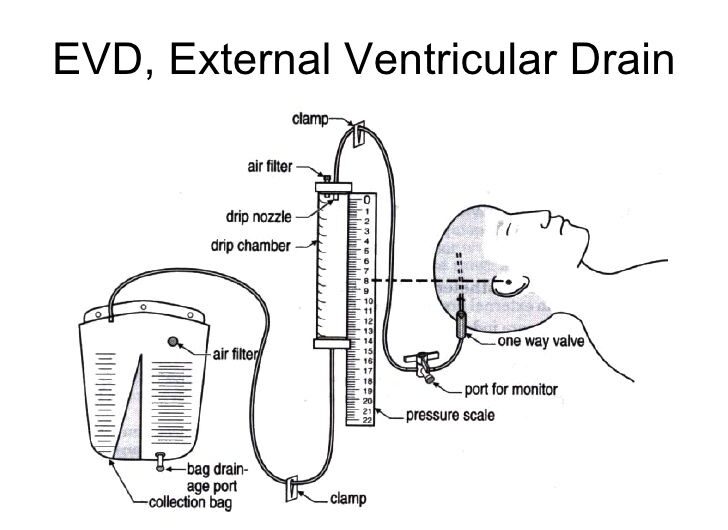 External Ventricular Drain Industry: New Advancements in Global External Ventricular Drain Market Innovations and Growth Trends