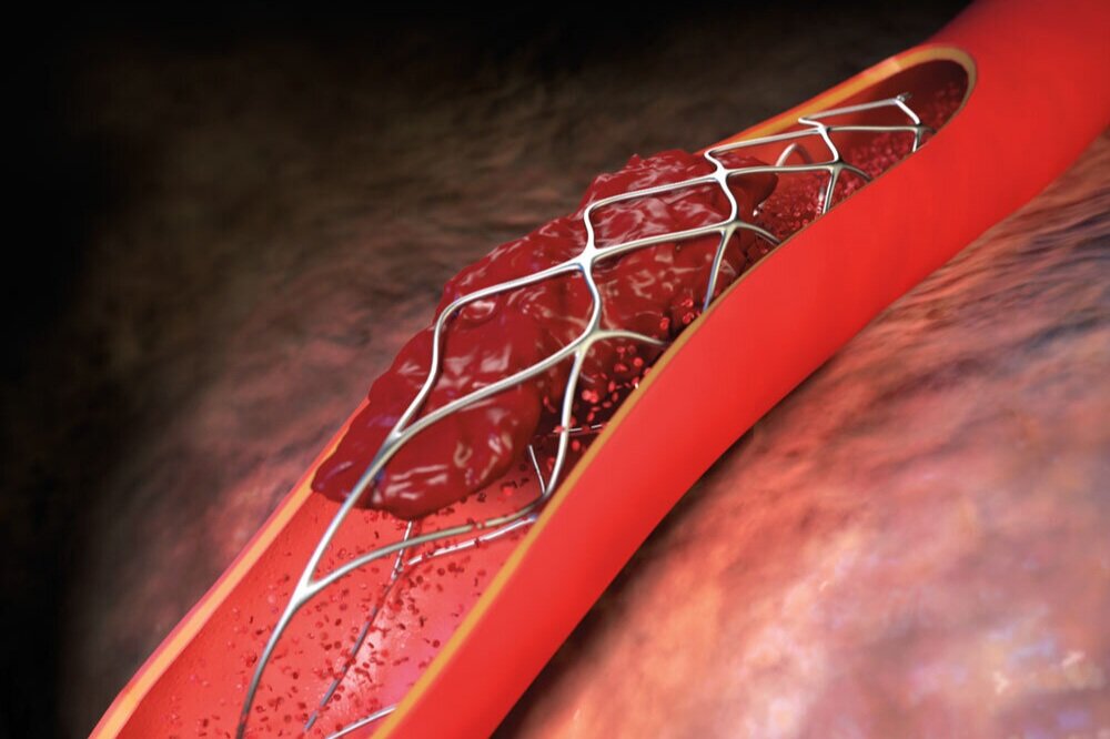 Global Lung Stent