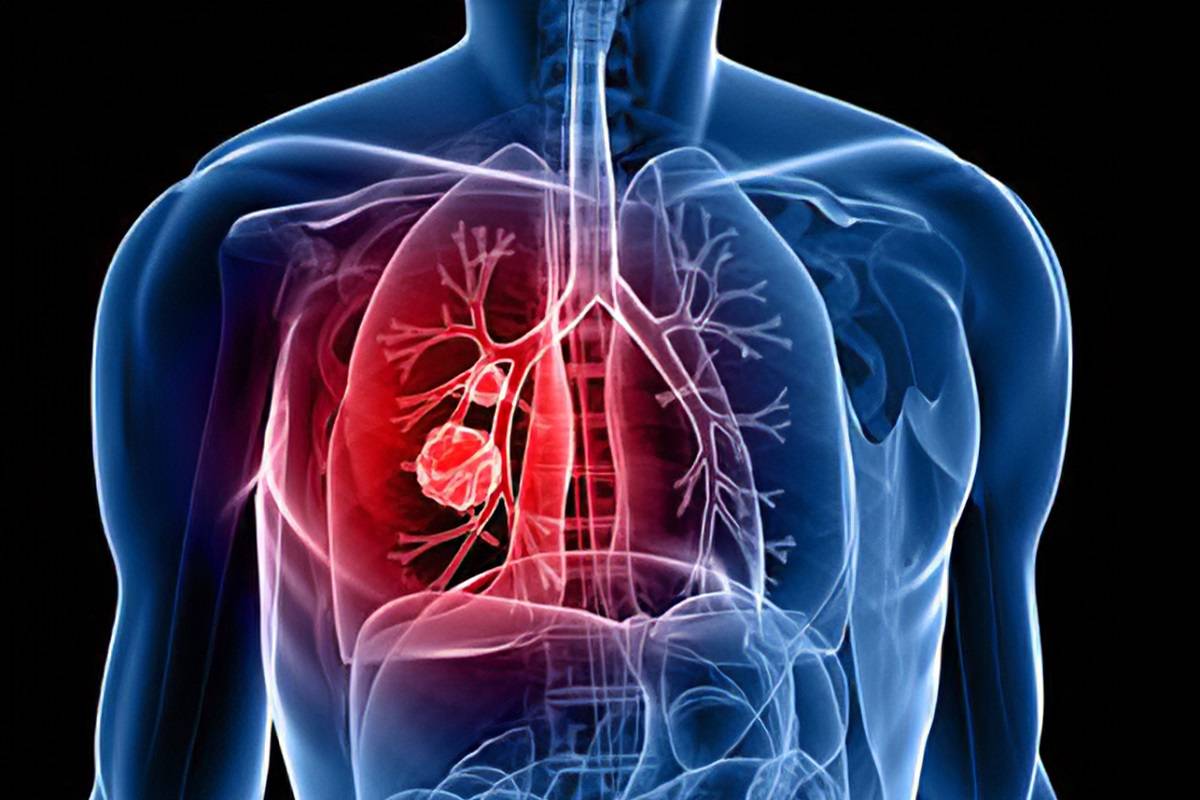 Respiratory Tract Infection Treatment