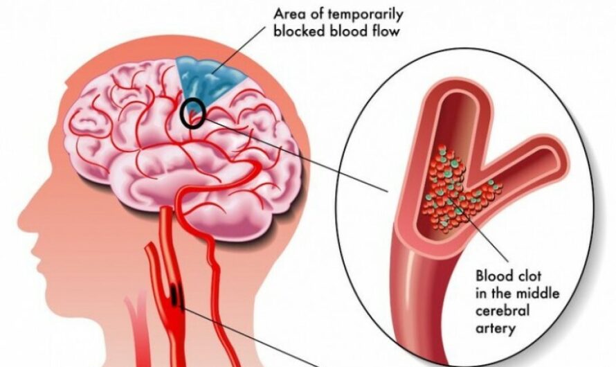 Acute Ischemic Stroke (AIS) Market Poised to Grow Substantially due to Rising Incidence of Strokes